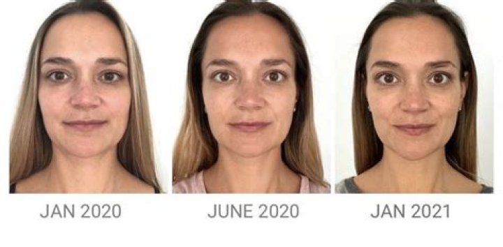 Face Yoga Before and After Photos That Prove The Benefits