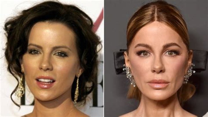 Kate Beckinsale Plastic Surgery: What Has She Done and Why?