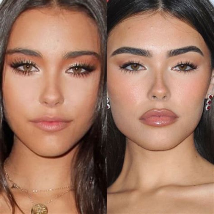 Madison Beer Before Surgery: What You Need to Know!