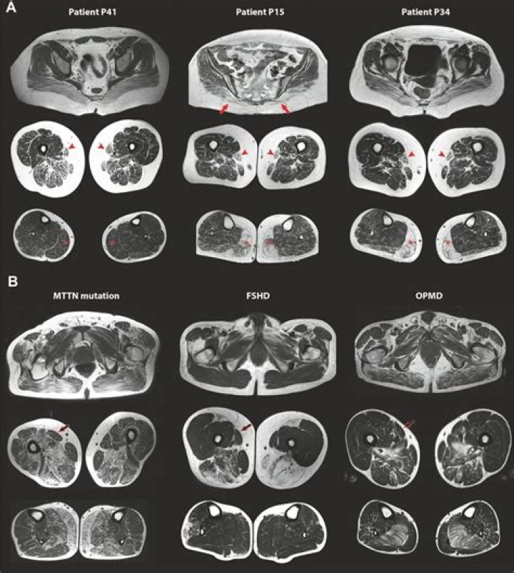 Muscle MRI characteristic pattern for late-onset TK2 deficiency diagnosis - ePrints