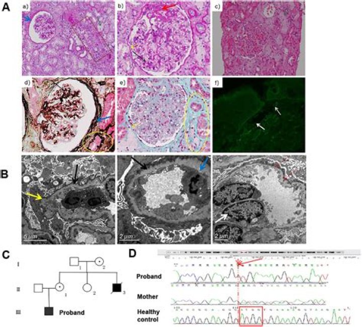 Pseudodominant Alport syndrome caused by pathogenic homozygous and compound heterozygous COL4A3 splicing variants - ePrints