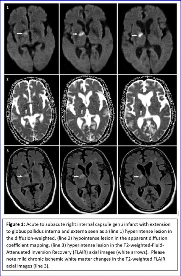 Repetitive hiccups sudden onset | Dementia Support Forum