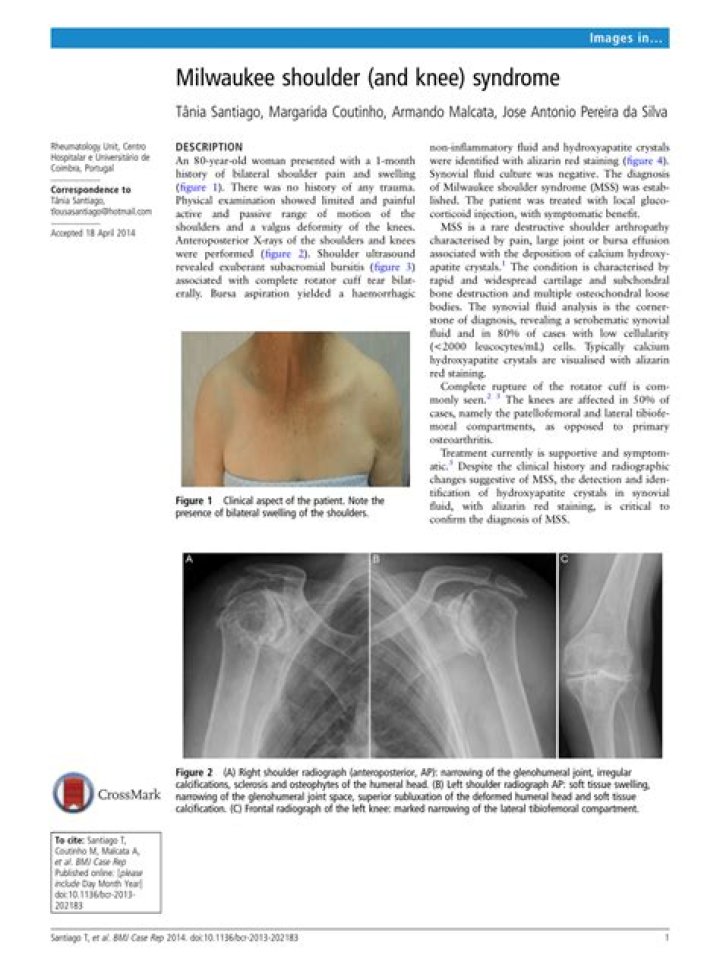 The Milwaukee shoulder/knee syndrome - ePrints